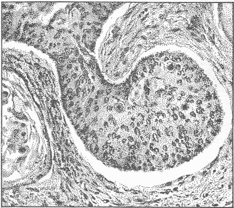Fig. 14&mdash;Photograph Of A Microscopic Preparation From A Cancer Of The Uterus. A large mass of cells is extending into the tissue of the uterus which is shown as the fibrous structure. Such a cell mass penetrating into the tissue represents the real cancer, the tissue about the cell masses bear the blood vessels which nourish the tumor cells.