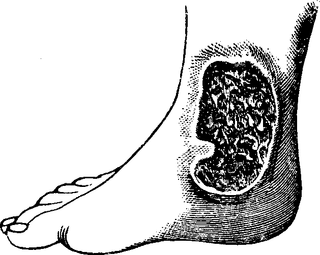 Illustration:
Fig. 2. A Chronic Ulcer.