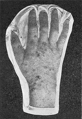 58. Scabies on the hand. From portfolio of Dermochromes
by permission of Rebman & Co., of
New York. Publishers.