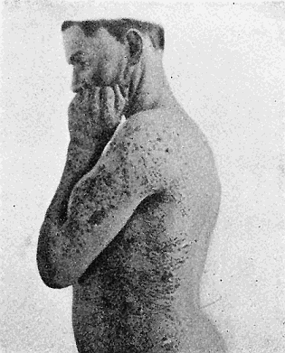 60. Generalized infection of Scabies.
After Morrow.