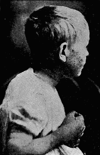 144. Pellagrous eruption on the face.
After Watson.